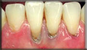 Surgical treatments for gum disease