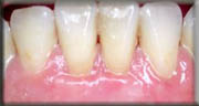 Surgical-treatments for gum disease