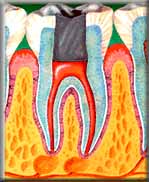 root-canals