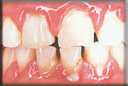 Non-surgical treatments for gum disease
